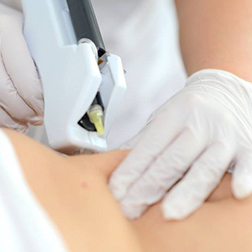 carboxiterapia